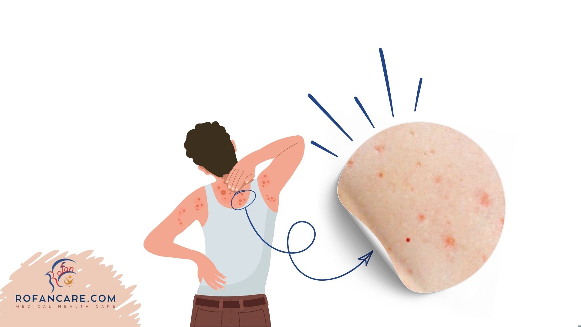 الحبرات أو النمشات (Petechiae): أسبابها وأعراضها وعلاجها